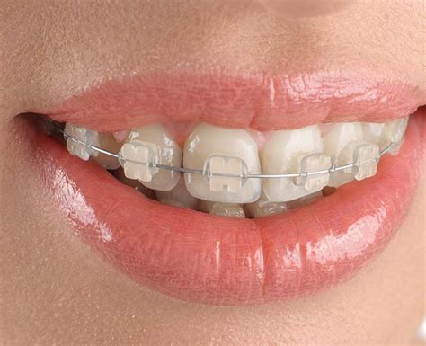 clear braces metal brackets|what are clear braces called.